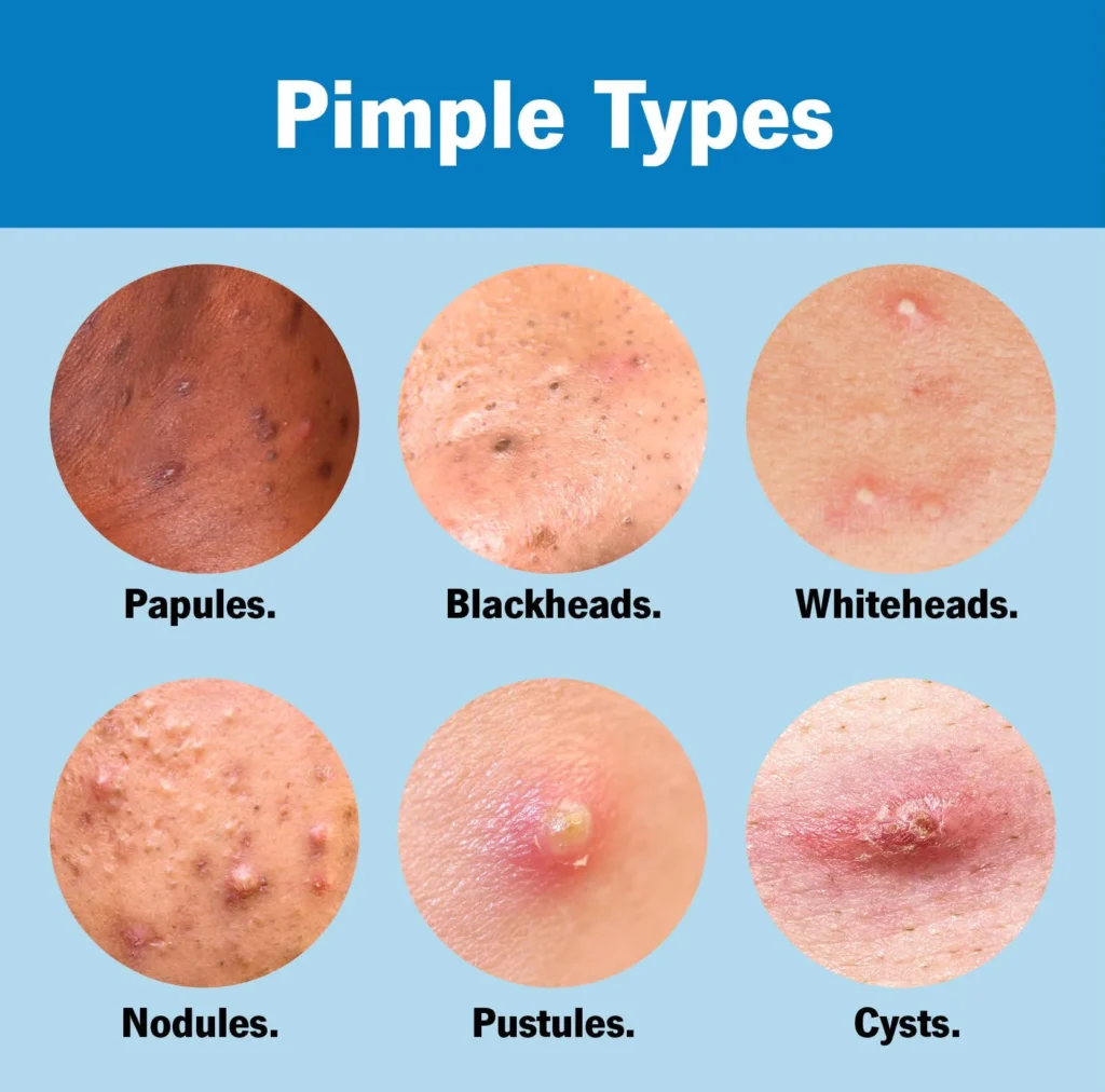 Types of SARMs caused pimples: papules, blackheads, whiteheads, nodules, pustules, cysts; comparison of acne variations.