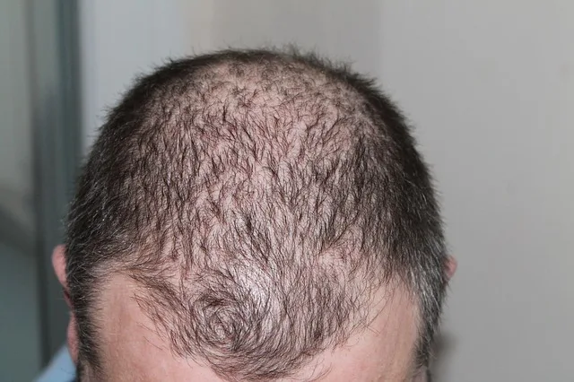 Male pattern baldness on scalp, illustrating SARMs trial hair loss focus for scientific hair regeneration study.