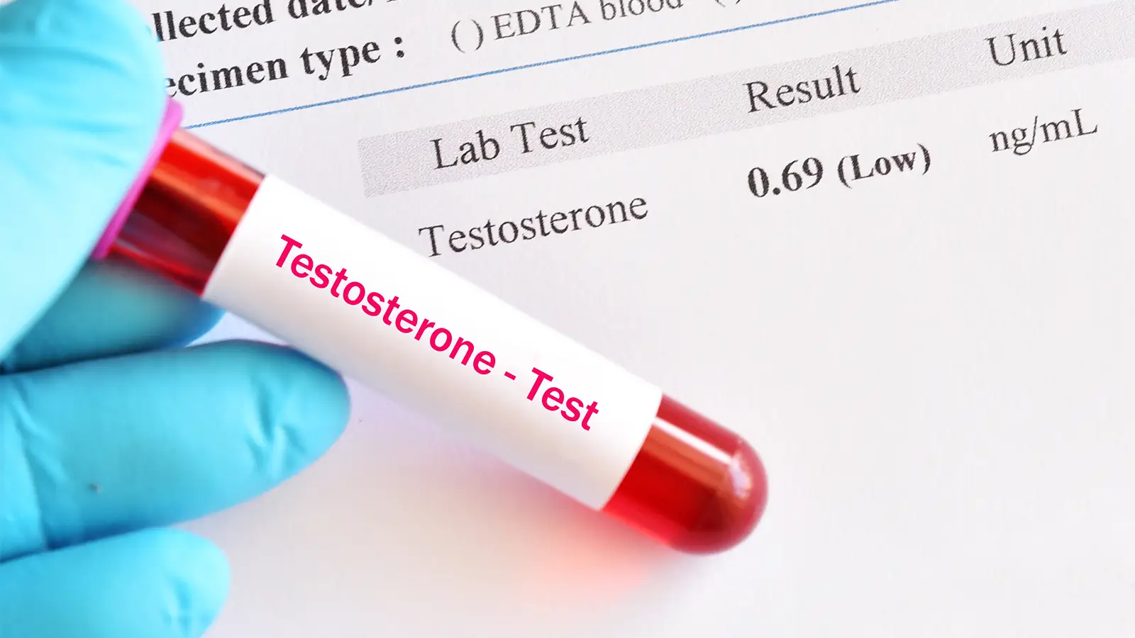 Testosterone test result showing low level at 0.69 ng/mL.