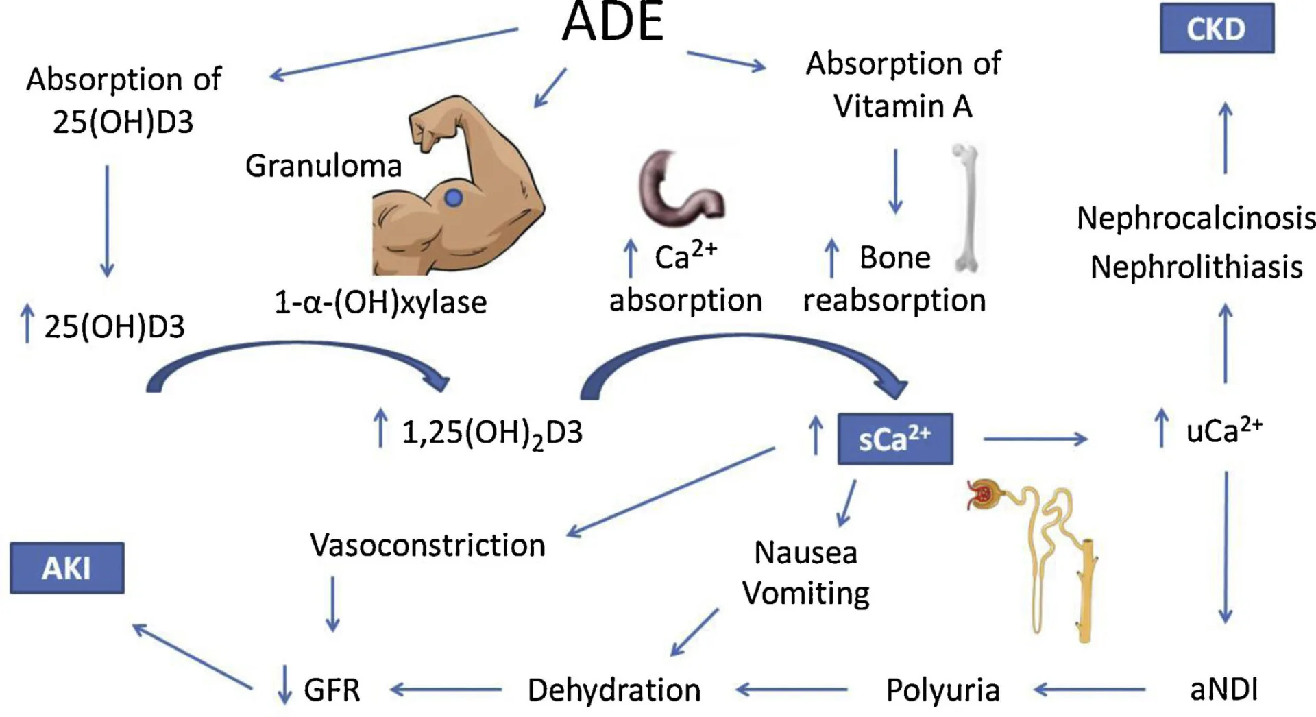 Anabolic steroid mechanism flowchart: ADE, CKD, AKI pathways; calcium absorption, nephrocalcinosis, dehydration causes.
